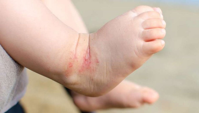 Dermatitis atópica: cómo cuidar la piel atópica